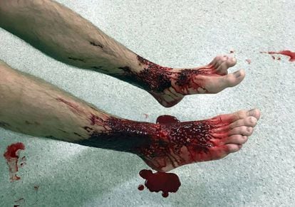 Os pés de Sam Kanizay depois do ataque, em foto tirada por seu pai