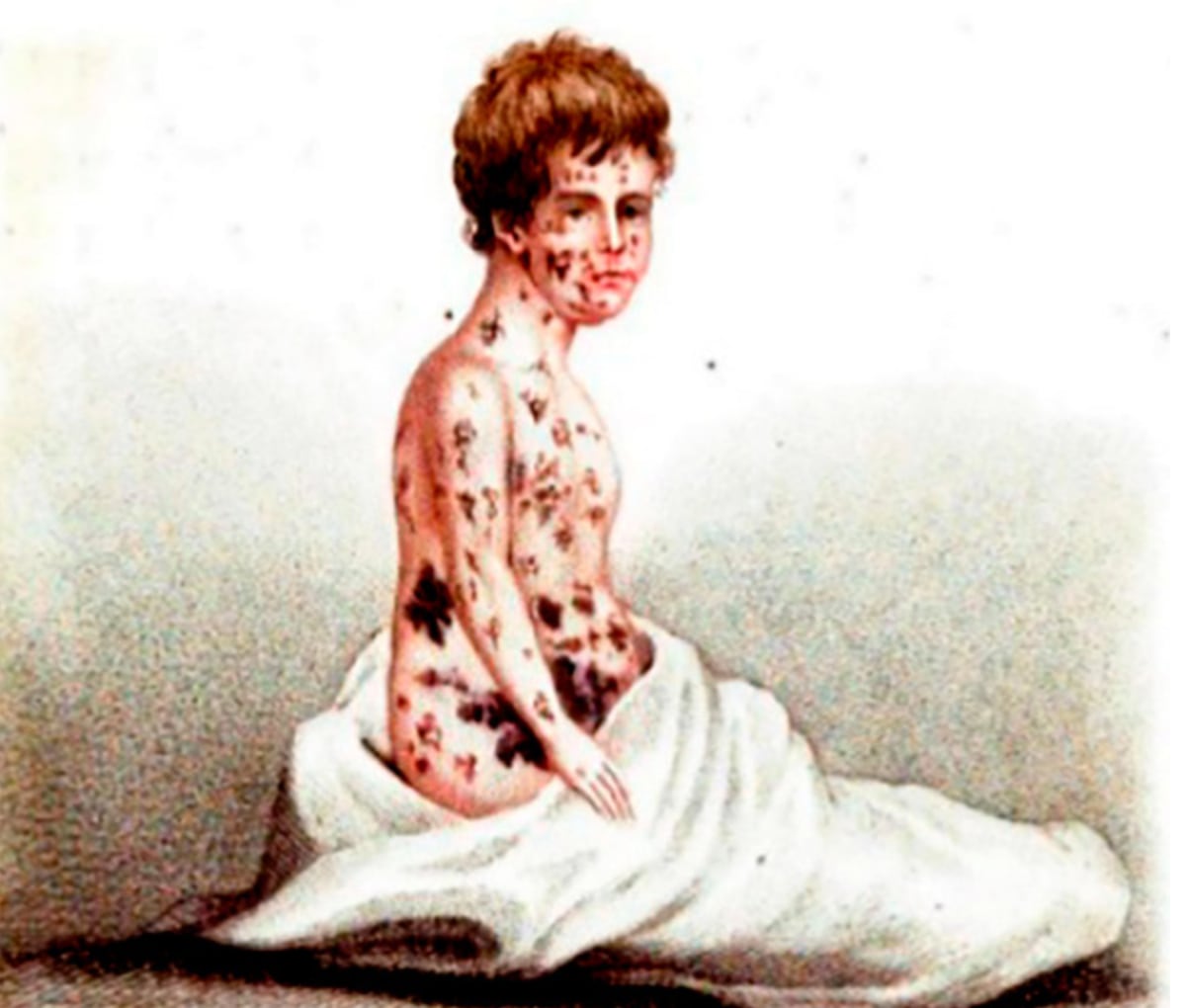 Ilustração do século 19 mostra marcas da varíola.