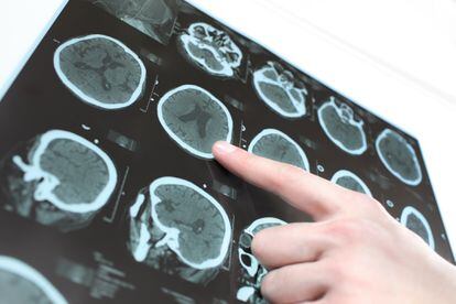 Um neurologista assinala as imagens de um cérebro humano obtidas por scanner.