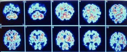 Imagens de um cérebro com Alzheimer.