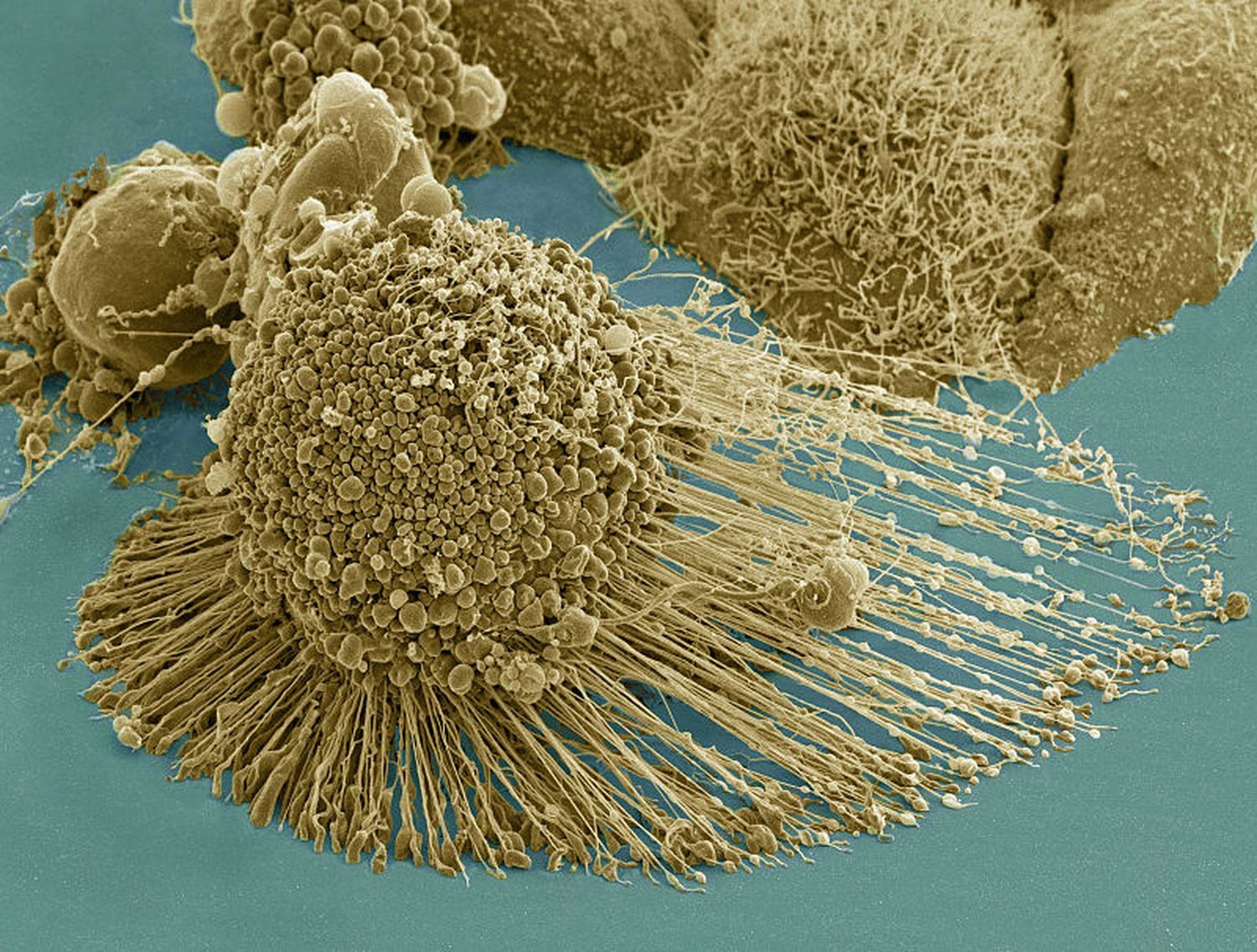 Células do câncer vistas com um microscópio eletrônico.