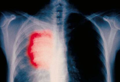 Radiografia de um paciente fumante de 58 anos com câncer de pulmão.