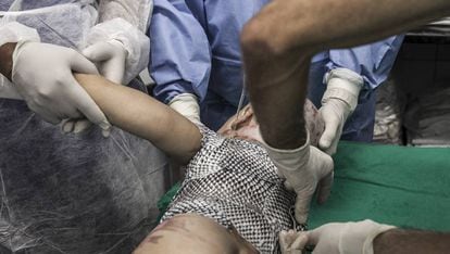 Médicos aplicam pele de tilápia em um bebê de um ano e meio, queimado com água quente, no Instituto Dr. José Frota.