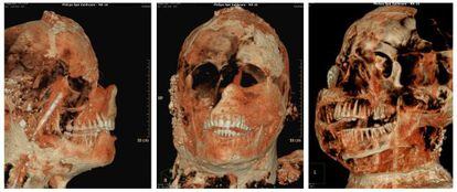 Tomografia axial computadorizada de uma das múmias de Pompeia.