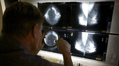 Um médico avalia os resultados de uma mamografia.