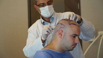 O cirurgião Abdullah Etöz marca as regiões da cabeça de seu paciente de onde serão extraídos os folículos capilares a serem implantados na parte superior.