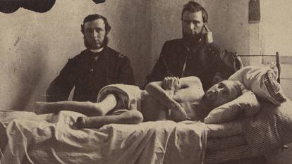 O cabo Calvin Bates no hospital, após sair de um campo de prisioneiros dos confederados em Andersonville.