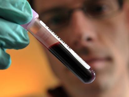 O novo exame de sangue para detectar a doença neurodegenerativa pode custar entre 376 e 1.135 reais.