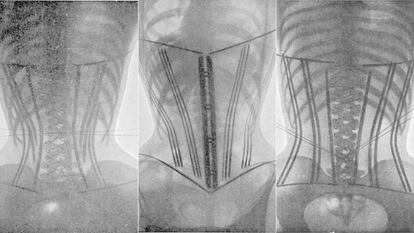Radiografias feitas por Wilhelm Röntgen de mulheres com espartilho.