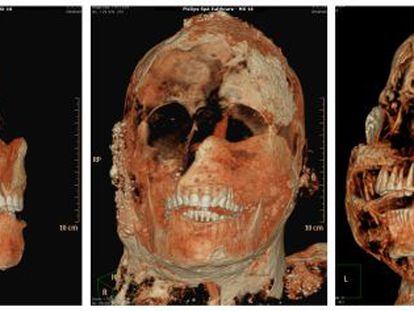Tomografia axial computadorizada de uma das múmias de Pompeia.