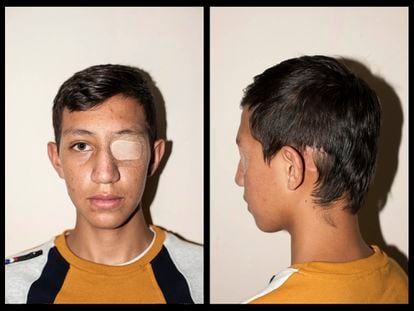 Nicolás Bernal, de 13 anos, sofreu um traumatismo craniano durante os protestos pelo impacto de uma granada de gás lacrimogêneo, em Bogotá, Colômbia. CAMILO ROZO