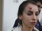 A jornalista Karla Silva depois da agressão de 2014