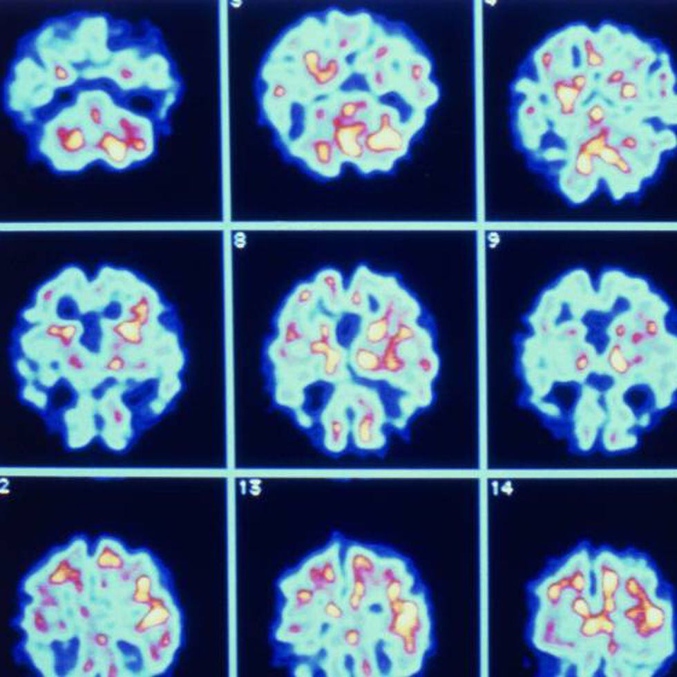 Como identificar o Alzheimer precocemente? – Metro World News Brasil