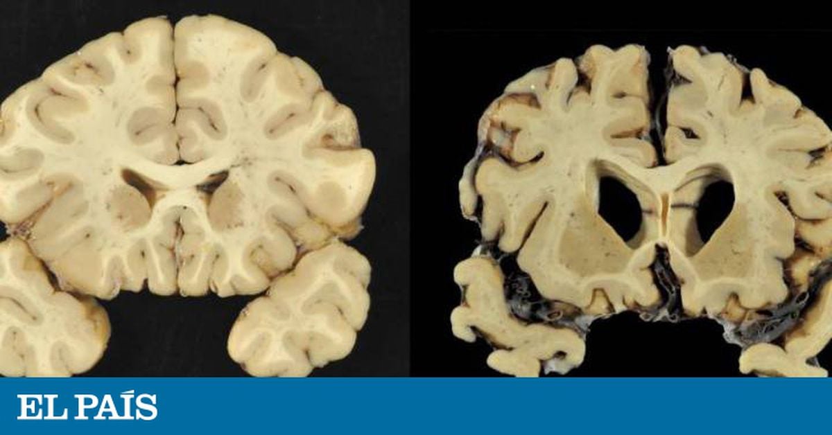 Agressividade, alzheimer e demência: Como as lesões afetam os jogadores de futebol  americano