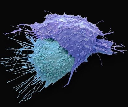 Células de cáncer de ovario vistas con microscopio electrónico.
