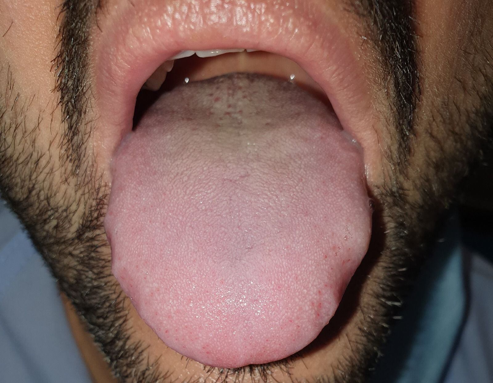 Língua dilatada e com marcas dos dentes nas laterais de um paciente com covid-19. HOSPITAL UNIVERSITÁRIO LA PAZ