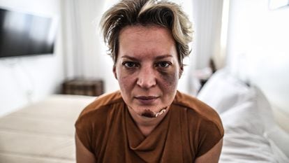 A deputada Joice Hasselmann (PSL-SP) é fotografada com hematomas no rosto em seu apartamento funcional em Brasília, na última sexta-feira.