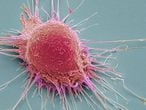 Célula de cáncer de próstata en una imagen de escáner coloreada