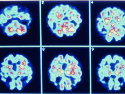 Imagens de um cérebro com Alzheimer.