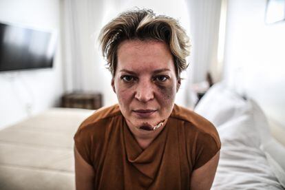 A deputada Joice Hasselmann (PSL-SP) é fotografada com hematomas no rosto em seu apartamento funcional em Brasília, na última sexta-feira.