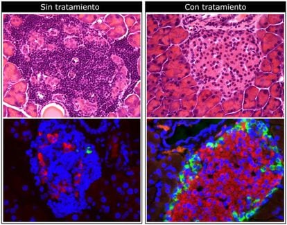 Imagens de microscópio do pâncreas em um animal de teste. Acima: a droga reduz a infiltração de células do sistema imunológico (pontos roxos mais escuros). Abaixo: o medicamento aumenta a produção de insulina (em vermelho)