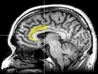 Neuroimagem do cérebro humano mostrando em amarelo a circunvolução cingulada anterior, uma região relacionada com a orientação ideológica das pessoas./