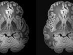 A la izquerda, imagen de alta resolución de un cerebro (B. L. Edlow et al, 7 Tesla MRI of the ex vivo human brain at 100 micron resolution. Scientific Data 6:244 (2019)  A la derecha la misma imagen comprimida al 95% con ondículas.