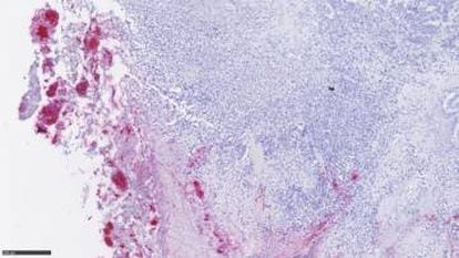 Um tumor colorretal infiltrado por 'Fusobacterium' (em vermelho).