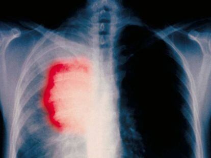 Radiografia de um paciente fumante de 58 anos com câncer de pulmão.