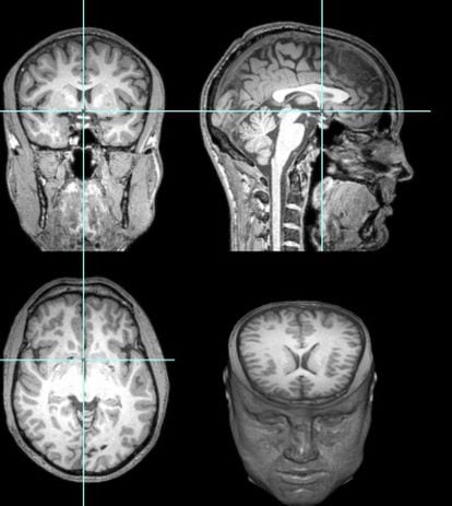 O xadrez realmente ajuda o cérebro? O que dizem os estudos