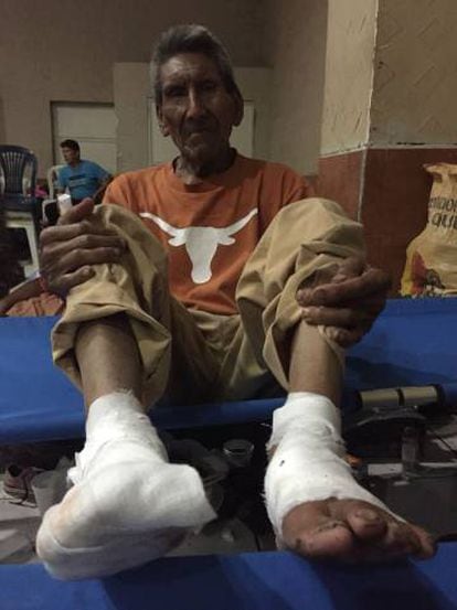 Domingo Lopez, de 79 anos, com os pés queimados pela lava
