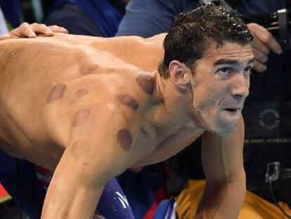 O nadador apareceu com marcas roxas nas costas, efeito de uma terapia chamada  cupping 