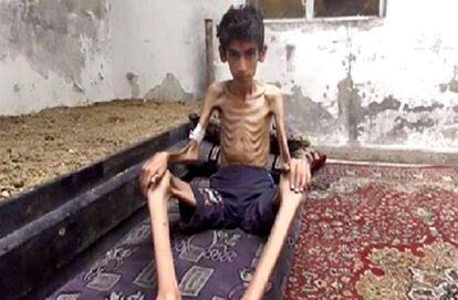 Uma das imagens que chocou o mundo: o impacto da fome na Síria.