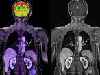 Imágenes médicas de un paciente con cáncer de pulmón.