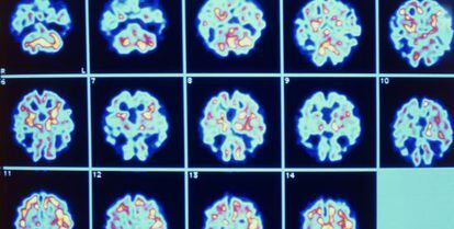 Imagens do cérebro de um paciente com alzheimer.