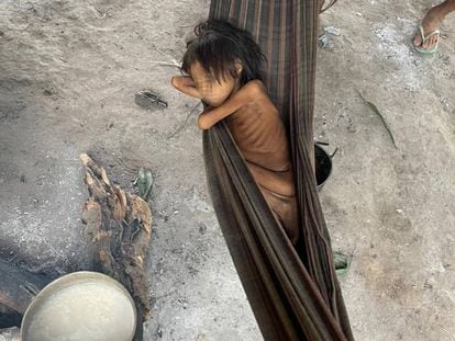 Criança Yanomami com desnutrição e malária, na aldeia Maimasi.