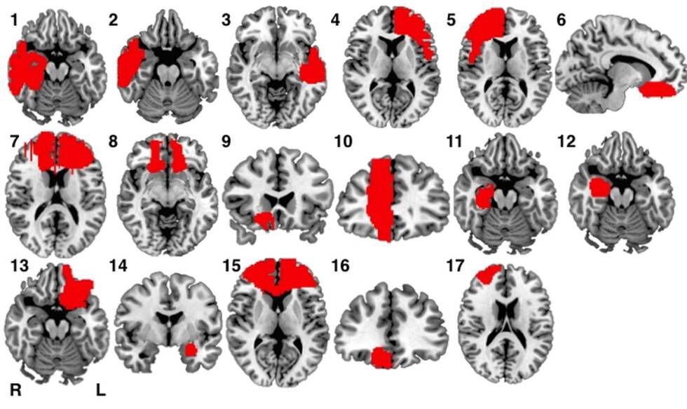 O exame de imagem do cérebro mostrou que todas as lesões ocorreram em regiões diferentes do cérebro. Aqui, imagens de 17 dos criminosos.
