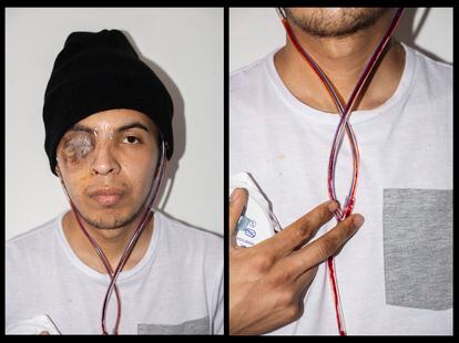 Jovens feridos nos protestos da Colômbia. Na foto, Juan Fonseca, que perdeu um olho. FOTO: CAMILO ROZO
