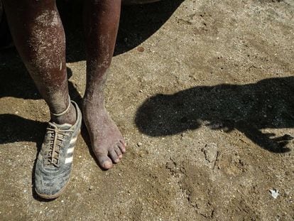 Um menino da favela da Cidade de Deus calça só um sapato. A redução da pobreza infantil é um dos grandes desafios do Brasil.