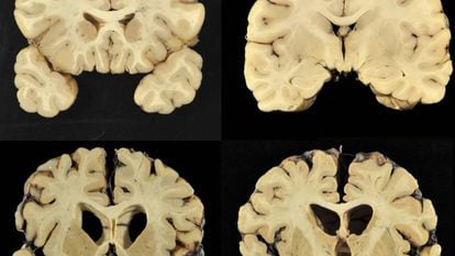 Acima, um cérebro normal; abaixo, um com ETC grau 4 em uma imagem do estudo.
