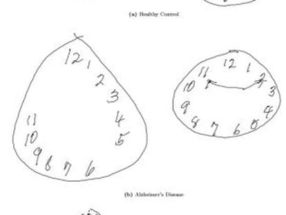 Na imagem são mostradas as diferenças nos desenhos de acordo com a doença. A primeira fila mostra dois relógios feitos por pacientes sãos. Na fila central, o paciente sofre de Alzheimer e na fila inferior, Parkinson.