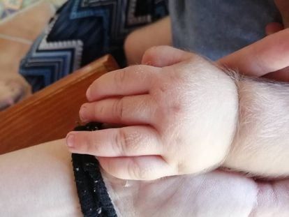 A mão de um bebê afetado pela síndrome do homem lobo.