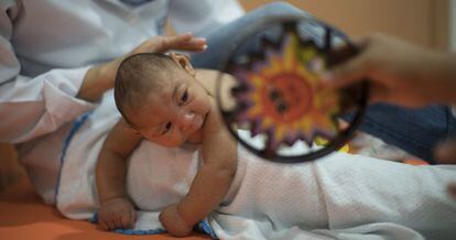 Uma criança com microcefalia em Recife, Brasil.