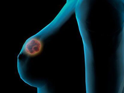 Recreação virtual de um câncer de mama.