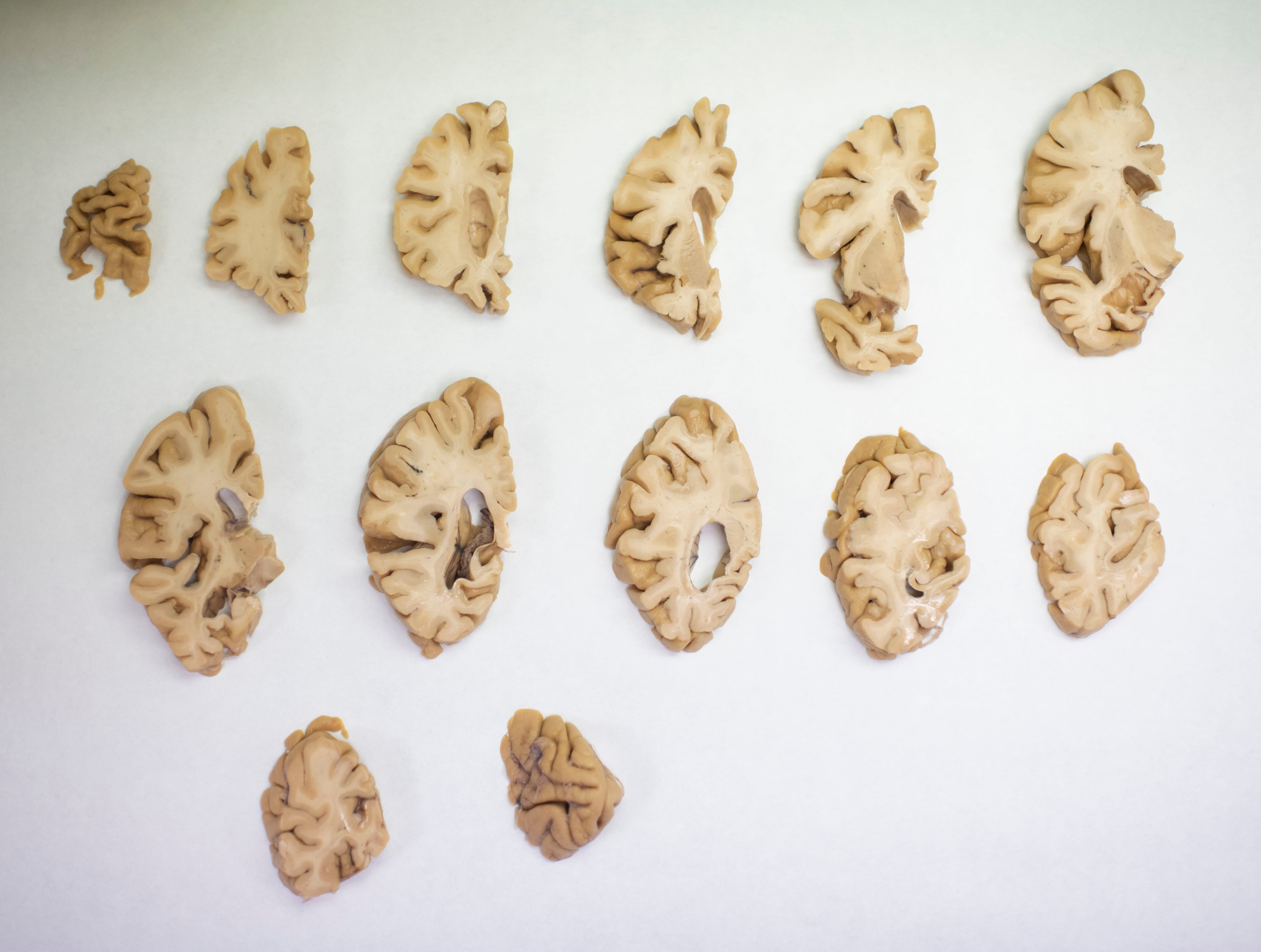Um cérebro humano dissecado na Fundação CIEN, em Madri. 