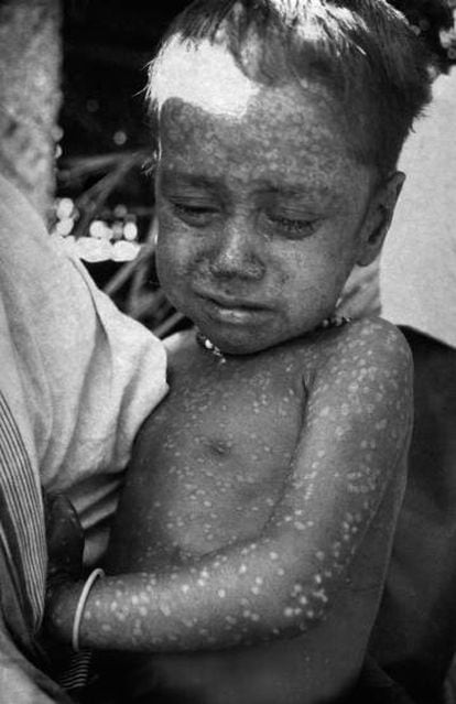 Rahima Banu, a última criança infectada de maneira natural pela cepa 'Variola major' da varíola em Bangladesh, em 1975.