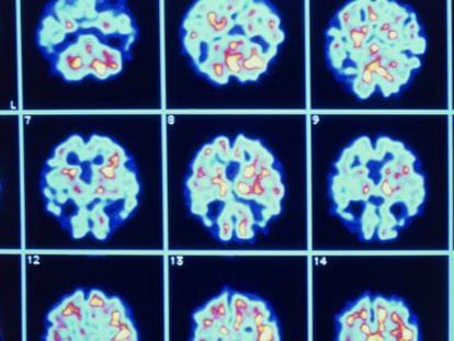 Imagens do cérebro de um paciente com alzheimer.