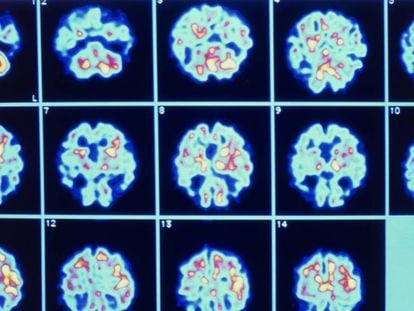 Série de imagens do cérebro de um paciente com Alzheimer obtidas através de PET.