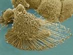 Células del cáncer vistas con microscopio electrónico.