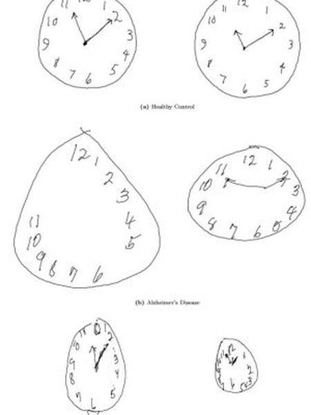 Na imagem são mostradas as diferenças nos desenhos de acordo com a doença. A primeira fila mostra dois relógios feitos por pacientes sãos. Na fila central, o paciente sofre de Alzheimer e na fila inferior, Parkinson.
